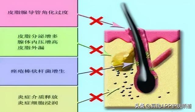 角化过度和角化不良