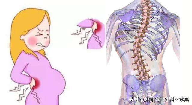 脊柱侧弯先手术再怀孕？还是先怀孕再手术？