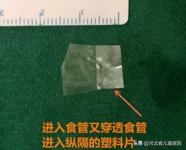 省儿童医院的紧急通知，一月内3例！警惕隐形“食管异物”