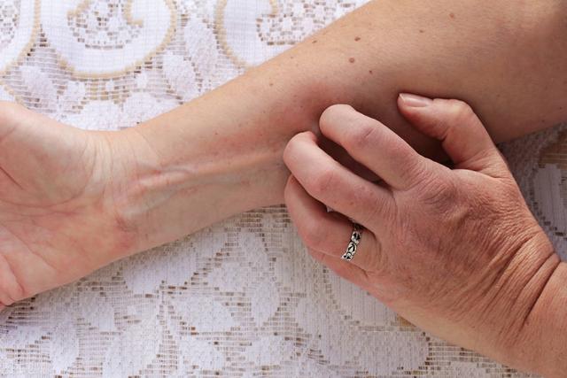 被猫身上的虱子咬了很痒怎么办(身上被跳蚤咬了图片)-艾拉养犬