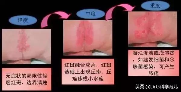 红疹抓破后呈鱼鳞状