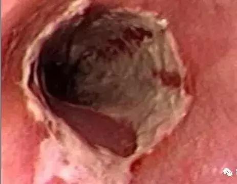 食管癌鳞癌角化型