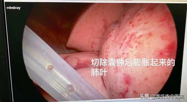 16个月宝宝右肺神秘“消失”