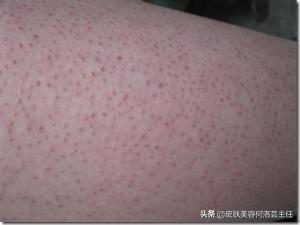 萎缩性红毛发角化症