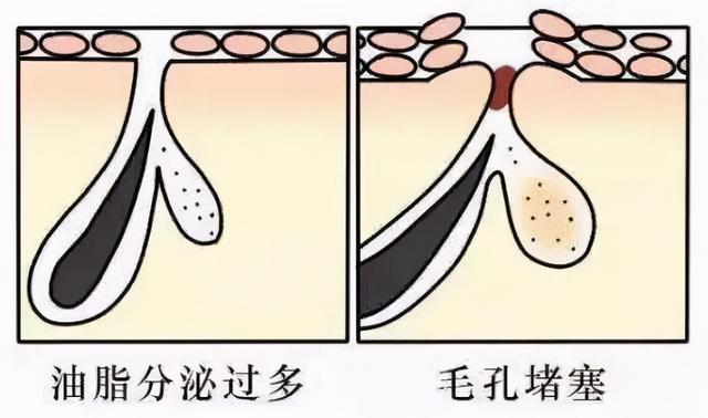水杨酸引起皮肤角化异常