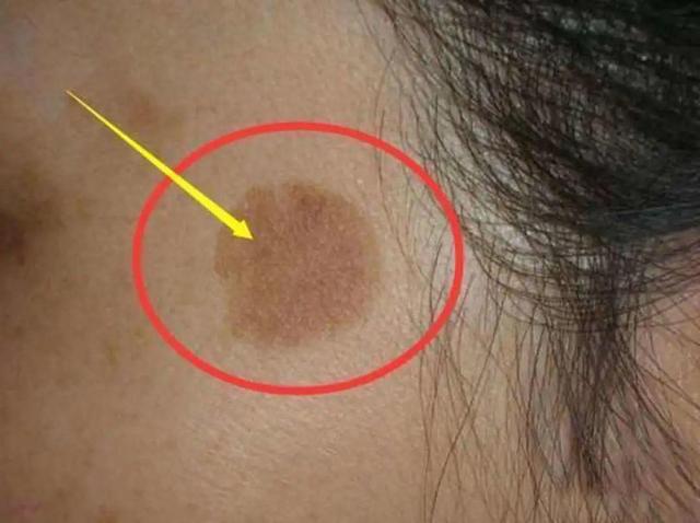 手点状角化与癌