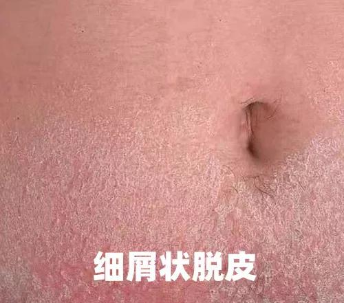 脖子皮肤像鸡皮是hpv吗