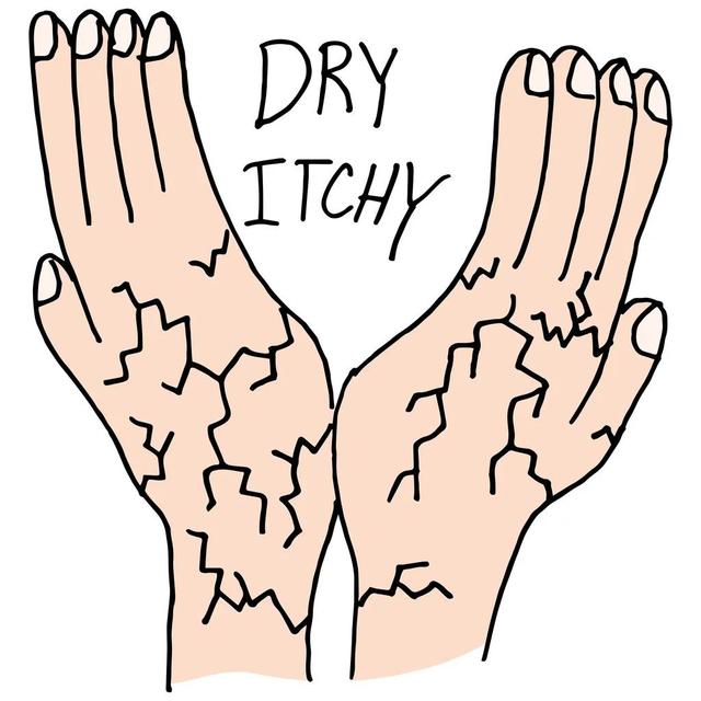角化型脚气尿素软膏