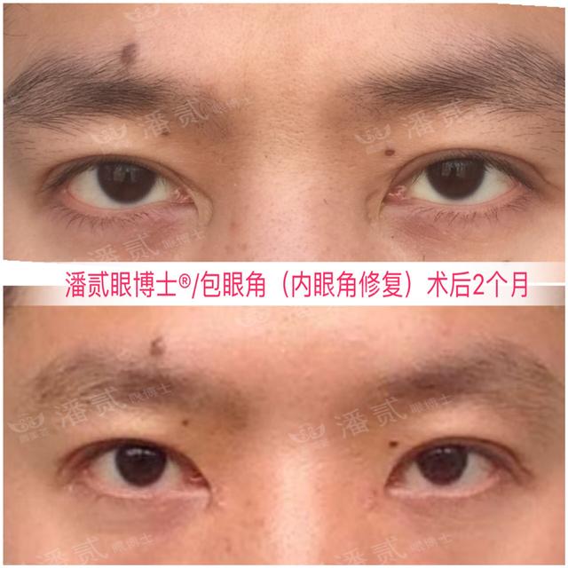 開了眼角後悔不已的案例 內眼角過大 露紅 括號 疤痕重 顯假 Kks資訊網