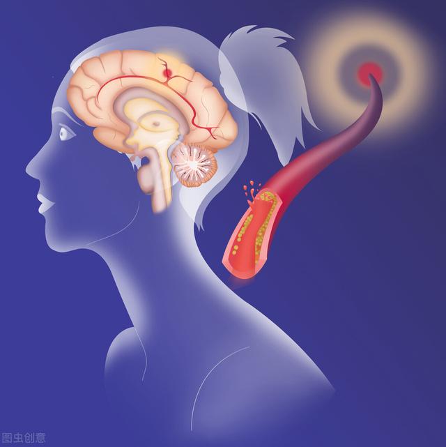 定期输液通血管，能预防中风？医生：预防中风有捷径，但不是输液