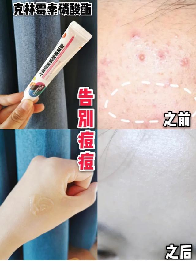 维a酸乳膏可以去周角化