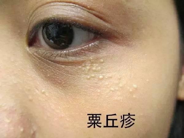 脂肪粒适合什么人吃脂肪粒适合什么护肤品