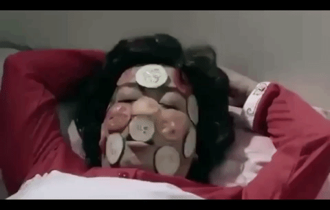鱼鳞病维生素a一天吃几粒