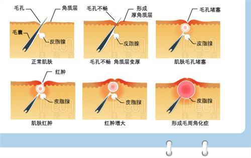 毛囊角化症怎么治愈