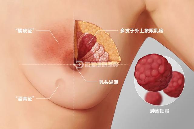 胸部有硬塊，是長了腫瘤嗎？這三步讓你充分了解自己的乳房，提高防癌意識