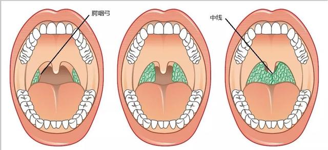 正常喉咙小舌头图片图片