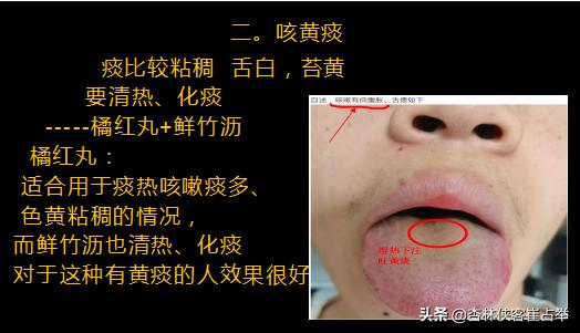 咳白痰、黄痰、清稀泡沫痰，3种情况3种原因，教你一分钟辨别