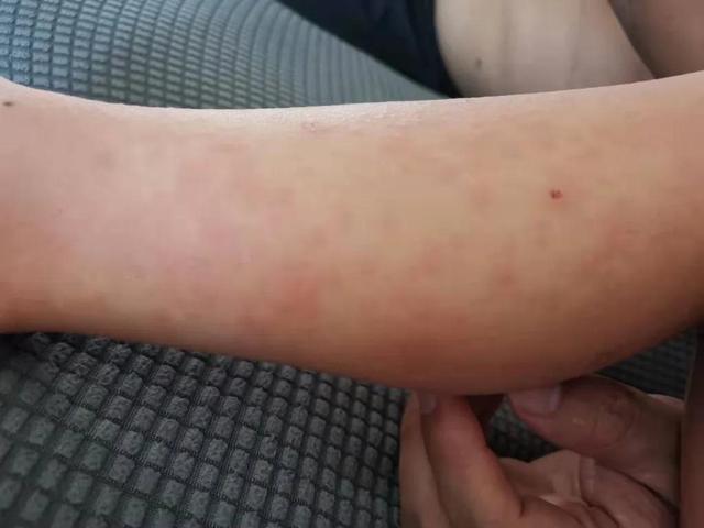 发热皮疹的孩子不少见，但这一例的诊断让人挠头