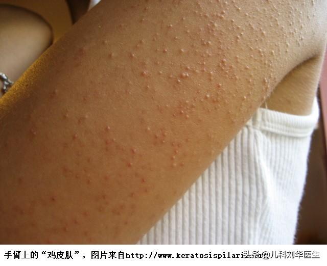 身上莫名起鸡皮疙瘩不痛不痒