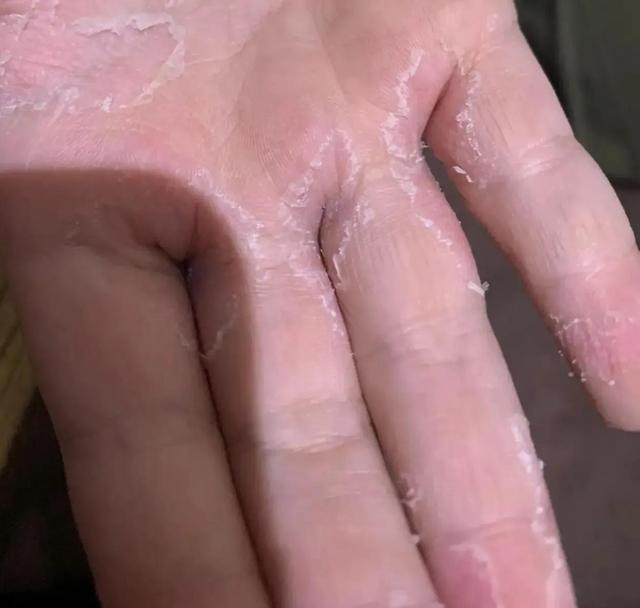 手指脱皮到疼不可忍，隔壁老太太：不用吃药，柴火烟熏一熏就好