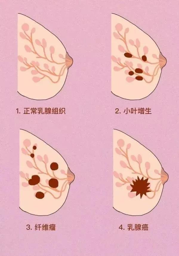 胸部有硬塊，是長了腫瘤嗎？這三步讓你充分了解自己的乳房，提高防癌意識
