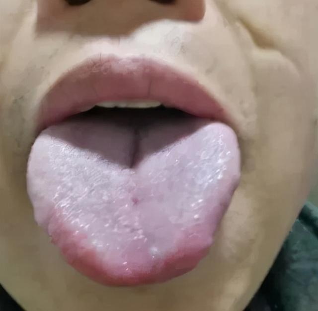 国医大师干祖望“宣肺法”治疗耳鸣耳聋，疗效甚佳