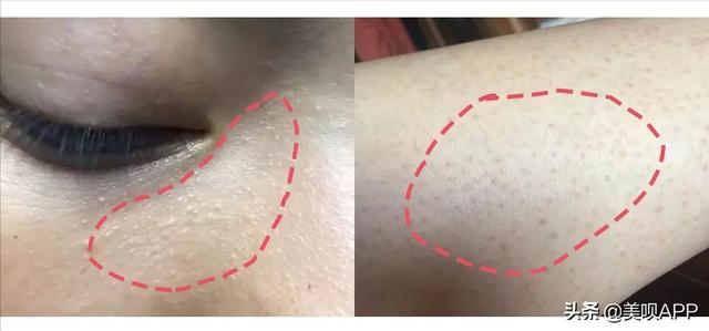 有毛周角化症怎么治