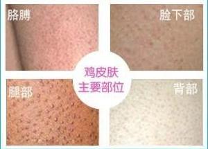 洗面奶能消除毛周角化吗