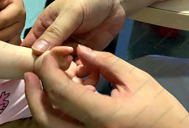 多指宝宝手术切除哪根手指比较好？切除后还会长出来吗？