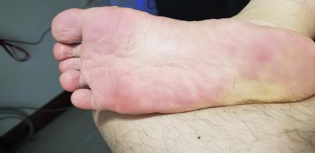 医生提示:糖尿病患者在出现糖尿病足时,早期一般有这3大症状