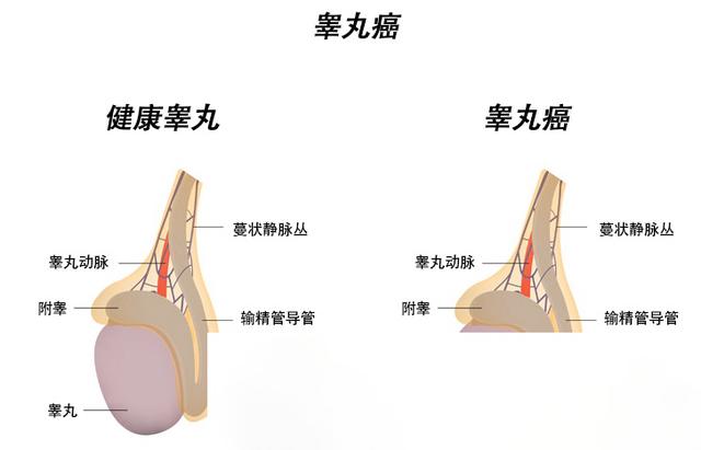 得睾丸癌的原因有哪些 应该如何预防 太阳信息网