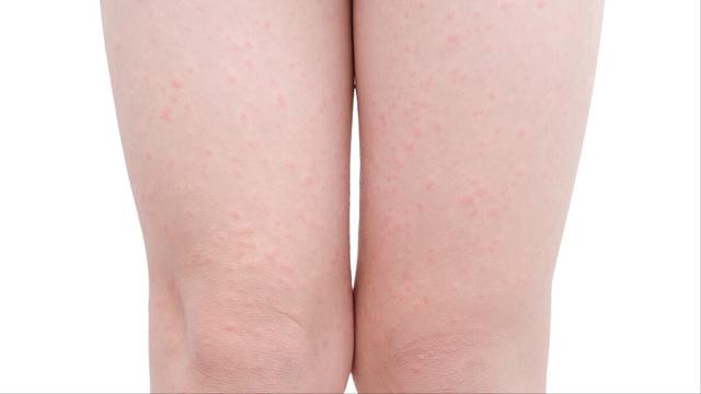 鸡皮肤能激光消除吗