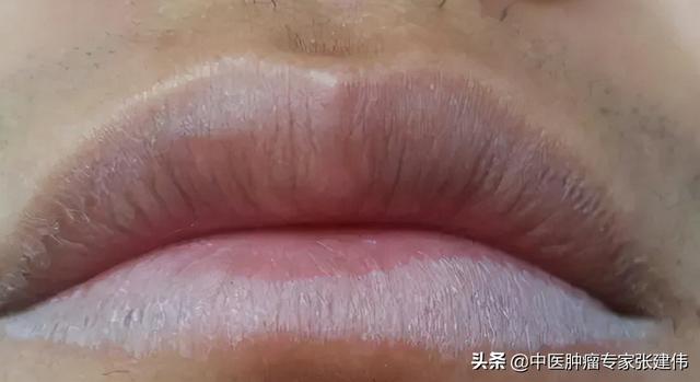 通過嘴唇顏色來“辨別”健康，快看看你的唇色是否健康