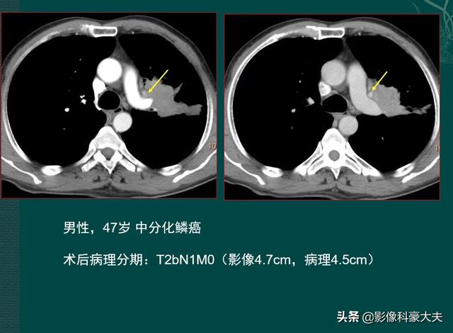 肺癌角化型鳞癌术后化疗