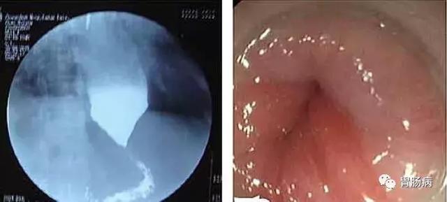 食管癌鳞癌角化型
