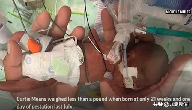 美国一男婴刷新最早早产儿世界纪录 提前132天出生 出生仅420克