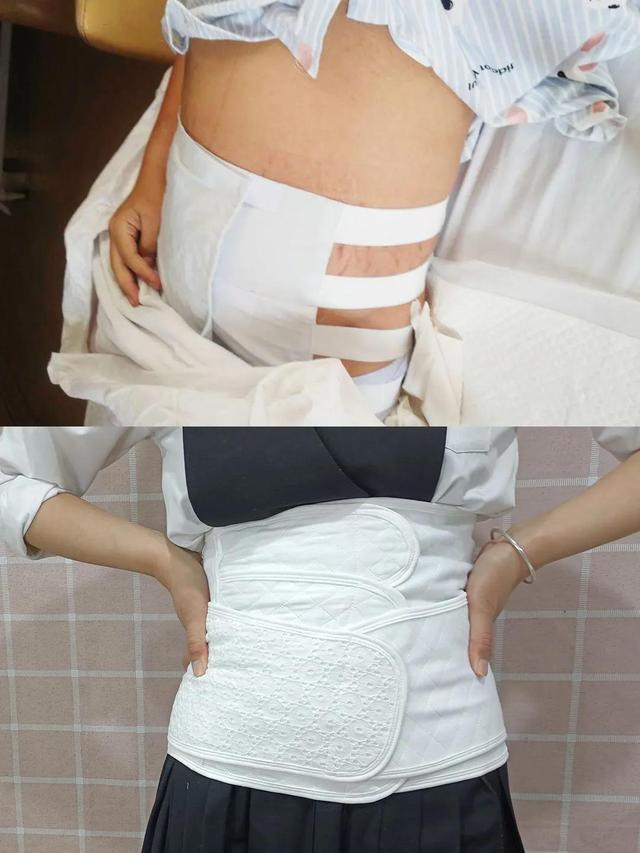 剖腹产一定需要收腹带？说说我的感受