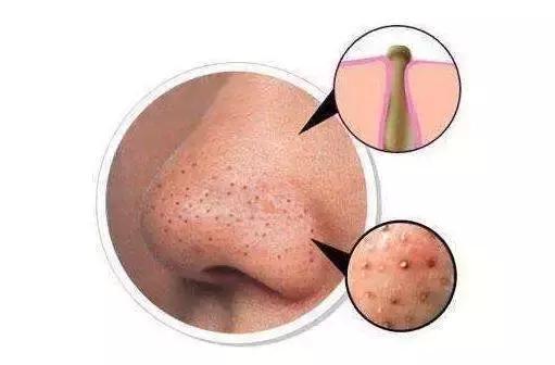 毛囊角化里面挤出来是白色的吗