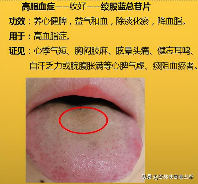 咽炎、高脂血症，四肢麻木，10个中成药，年过35岁后要收藏备好