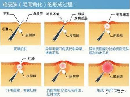 鸡皮肤会不会遗传下一代