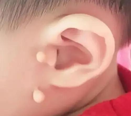 小孩大耳巴的症状图片图片