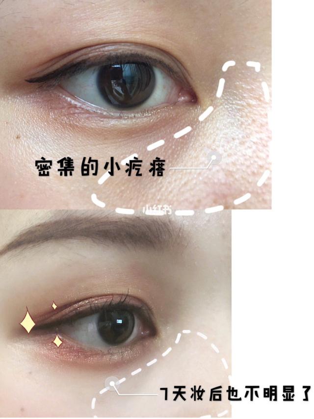 激光能去除毛周角化