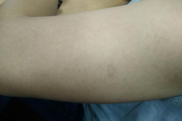 青春期鸡皮肤很严重