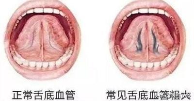 舌头上有瘀点是体内堵了吗？瘀血体质有什么特点，应该怎么调理？