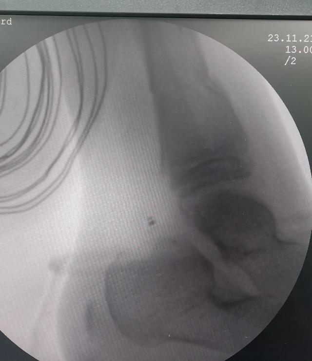 小儿胫骨远端骨折临床总结