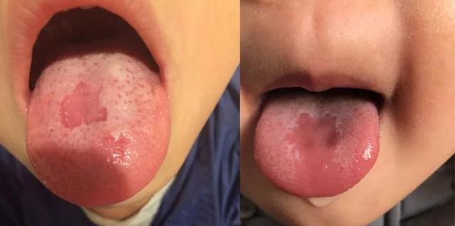 孩子舌苔脱落究竟是怎么回事？
