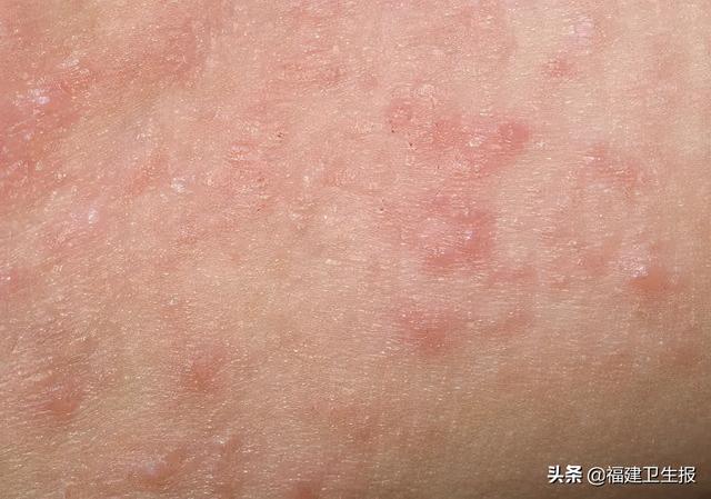 四岁宝宝腿上长鸡皮疙瘩