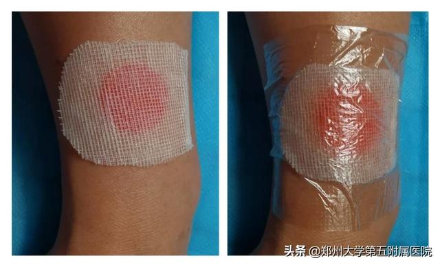 治疗宝宝的“红胎记”，您做对了吗？