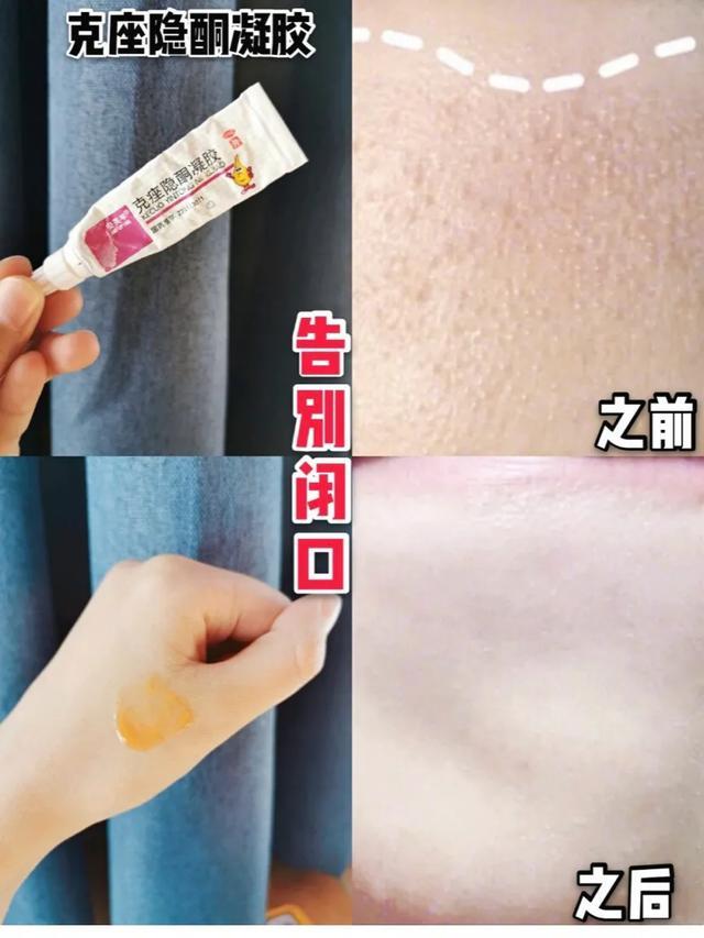 维a酸乳膏可以去周角化