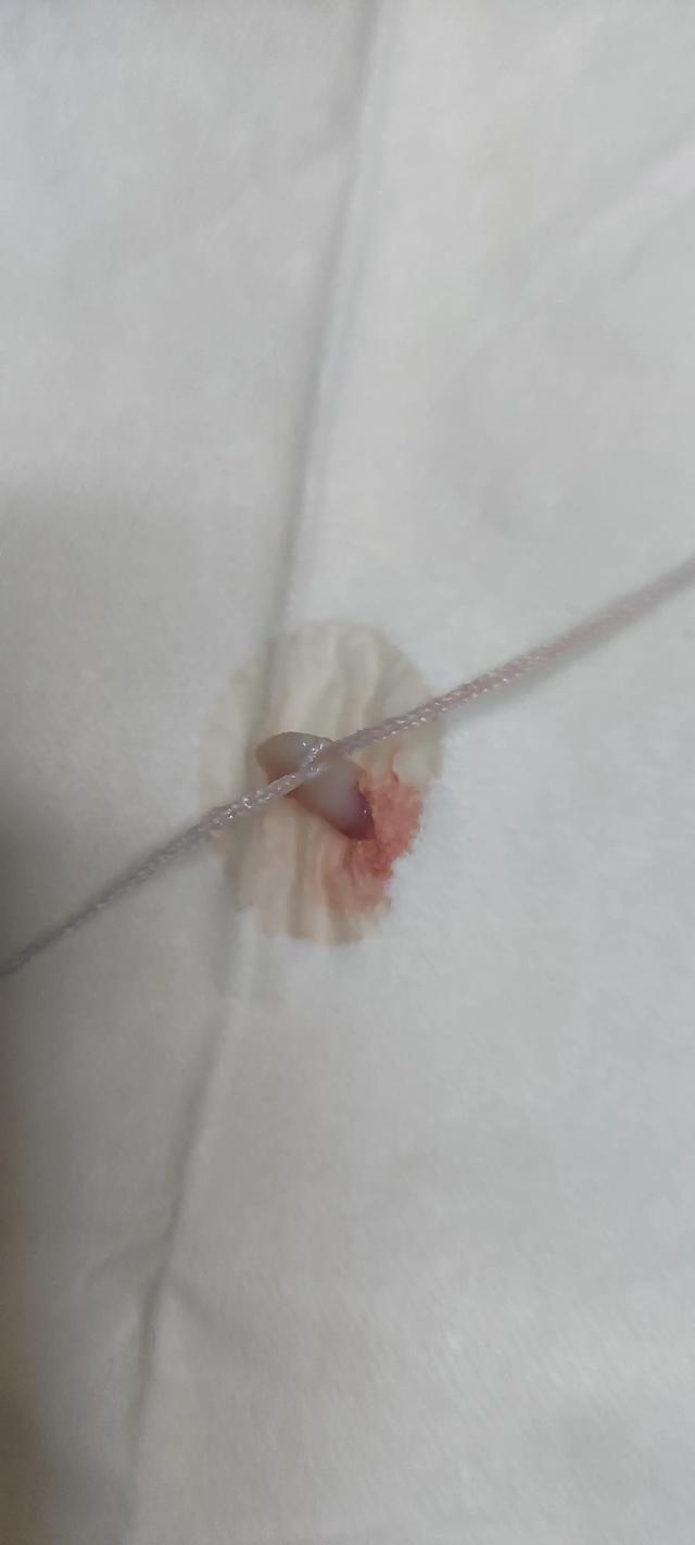 小朋友的牙可以这样拔？